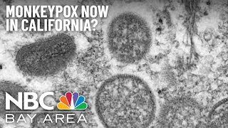 California Reports First Suspected Monkeypox Case in Sacramento County
