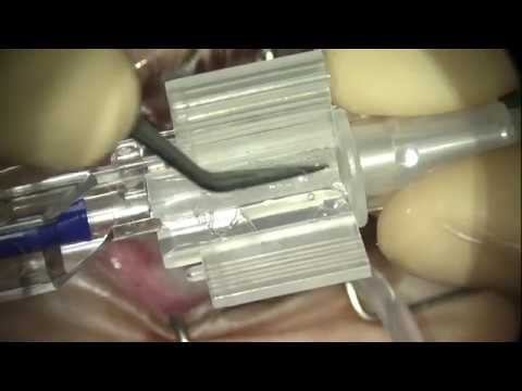 FIL SSF — Tips and Tricks