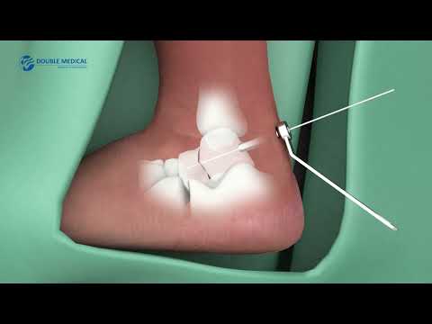 Headless Cannulated Screw