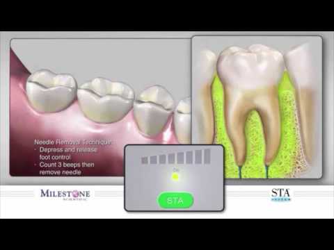 The Wand® STA Instrument - Intraligamentary PDL Injection