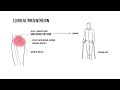 Transient osteoporosis of the hip – pathophysiology & diagnosis
