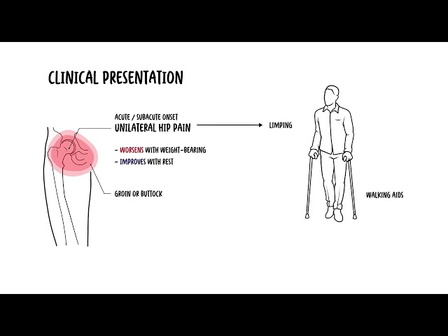 Transient osteoporosis of the hip – pathophysiology & diagnosis