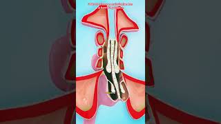 Balloon Sinuplasty Procedure 3D Animation