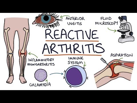 Ankylosing Spondylitis Visual Explanation for Students