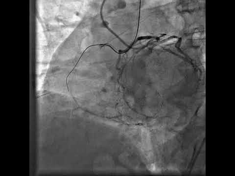 RCA CTO Intervention.