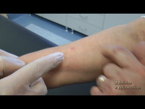 Pertinenza di una psoriasi di problema La dermatite di atopic può essere avventata