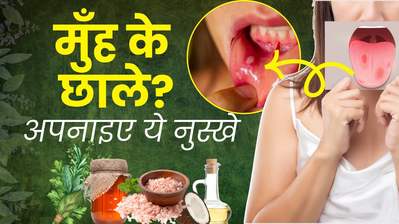 5 Mouth Ulcers I Aasan Nushkhe Behtar Zindagi