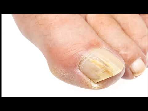 Tratamentul ciupercilor de pe unghie cu iod