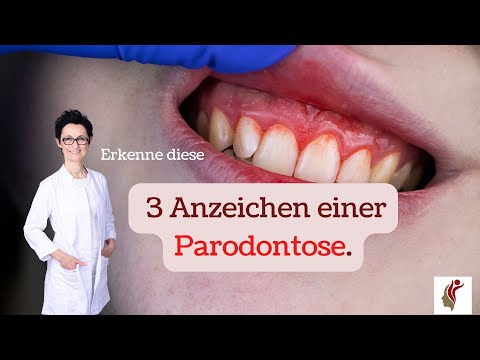 3 Anzeichen für Parodontose