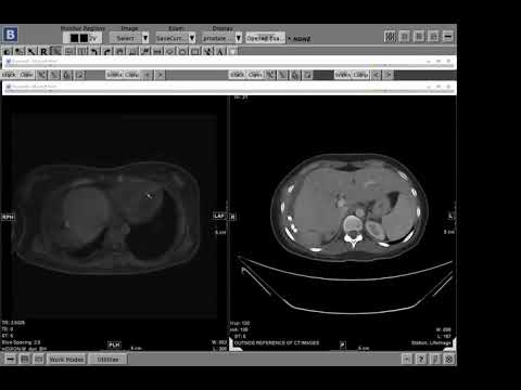 Best way to diagnosis biilary leak? Dr. Victoria Chernyak