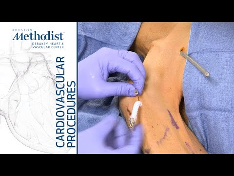 Hero Graft Placement: ISEVS Symposium 2019 (Eric K. Peden, MD and Edward Andraos, MD)