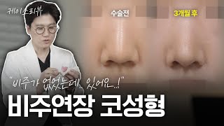 “짧은비주+짧은코+약한 구조의 연골” 기증늑과 근막 활용한 여성스러운 코라인 개선 무보형물 코성형 3개월 케이스리뷰