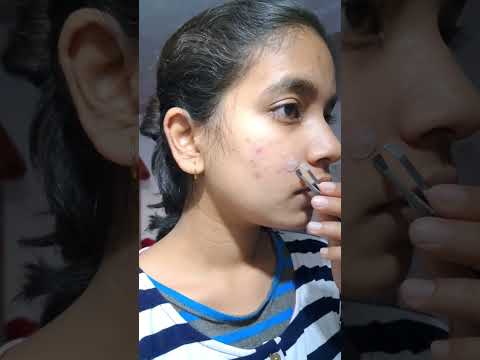 Modulyss 36 pcs acne pimple patch, pimple patch, transparent...