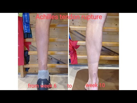 Achilles tendon rupture. 6-10 week Rehabilitation protocol. Riabilitazione rottura tendine d'Achille