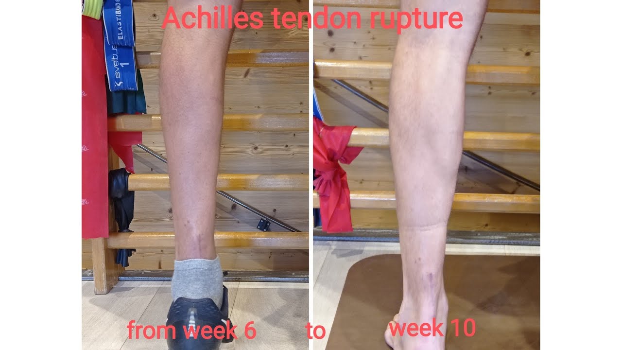 Achilles tendon rupture. 6-10 week Rehabilitation protocol. Riabilitazione rottura tendine d'Achille