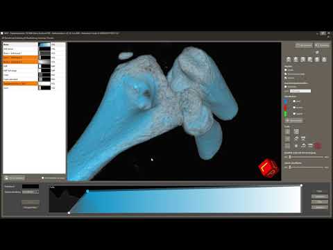 NewTom 7G - Ellenbogen Fraktur