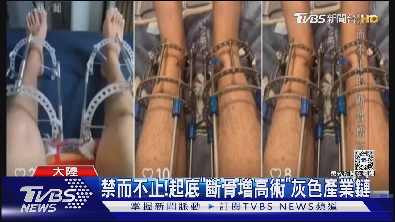 禁而不止!斷骨增高術後 女子腿部嚴重感染