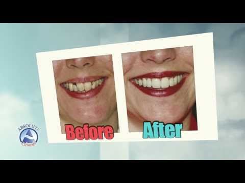 download lagu mp3 mp4 Absolute Smile Dental, download lagu Absolute Smile Dental gratis, unduh video klip Absolute Smile Dental