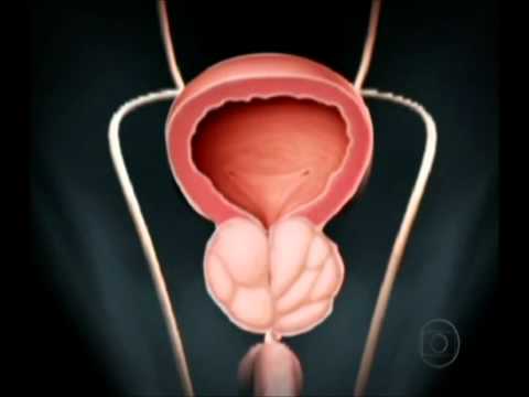 Prostata massaggio quante volte si può fare Trattamento di lavaggio prostatite