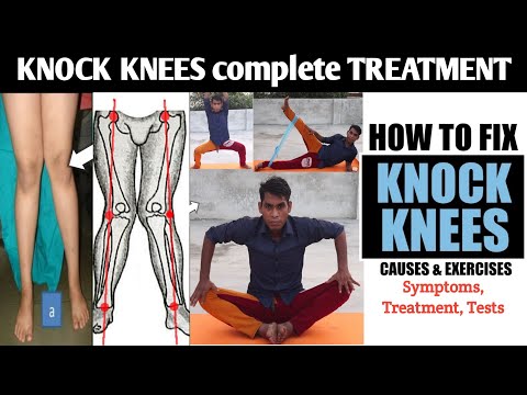 🦵 knock knees causes and treatment // knock knee correction exercise, genu valgum ko kaise thik kare