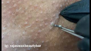 Ingrown Hair Removal Clipja Com