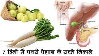 7 दिनों में पथरी पेशाब के रास्ते निकाले ॥ Home Remedies for Kidney Stones  Hindi