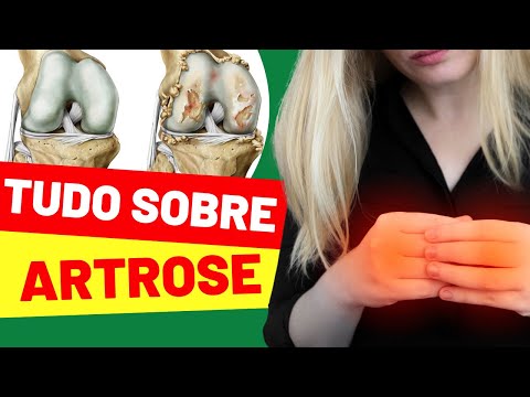 TUDO QUE VOCÊ PRECISA SABER SOBRE A ARTROSE!