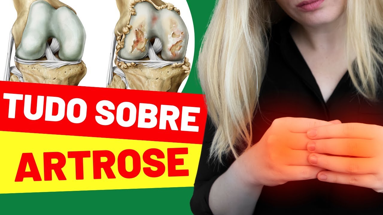 TUDO QUE VOCÊ PRECISA SABER SOBRE A ARTROSE!