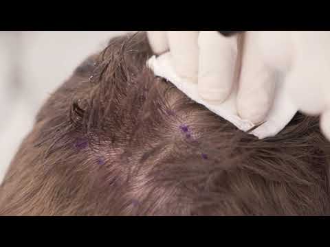 Celebrity Hair Transplant™ by Dr. Parsa Mohebi