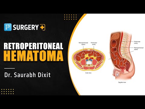 Retroperitoneal Hematoma by Dr. Saurabh Dixit | PrepLadder NEET-SS