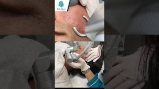 CO2 laser for acne scars | #shorts #co2laser #acnescars