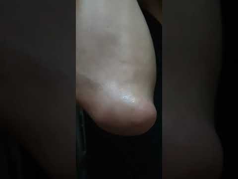 Bệnh U Bướu, Quai Bị ( Trừ Bướu Cổ)