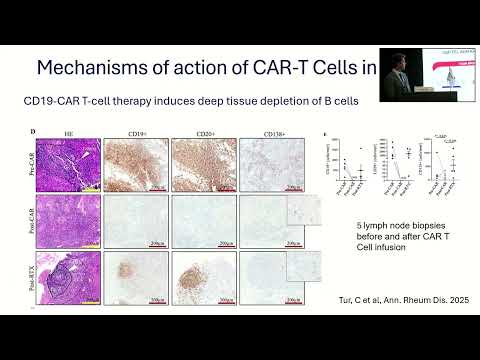 4. CAR in autoimmune disease | Dr. Giorgio Orofino | May 10, 2025