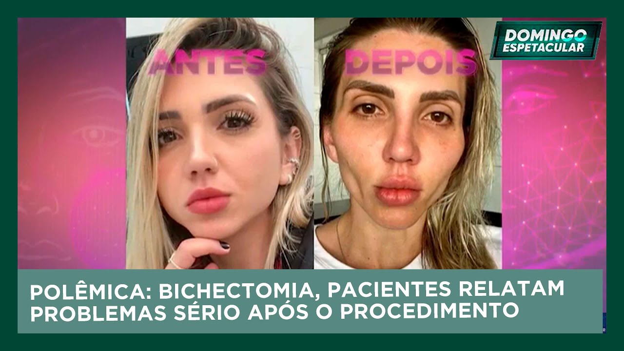 Domingo Espetacular: POLÊMICA: Pacientes relatam problemas sério após bichectomia