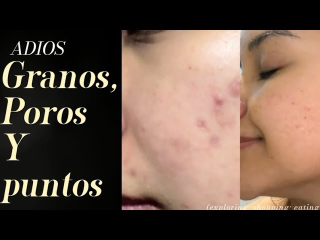 Vídeo relacionado con Anua Heartleaf Quercetinol Pore Deep Cleansing Foam, limpiador facial con ácido hialurónico (BHA), limpieza profunda de poros, eliminador de puntos negros, piel grasa, skincare coreano, 150ml