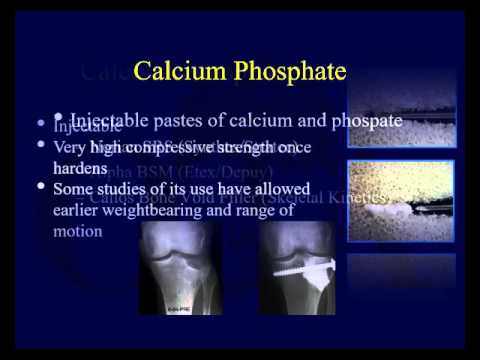 image-What is a bone substitute called?