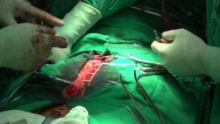 preview picture of video 'Cirurgia Cardíaca na Santa Casa de Misericórdia de Itabuna 2'