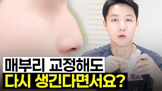 이거 실화? 매부리교정 하려고 코성형했는데 다시 생긴다고??