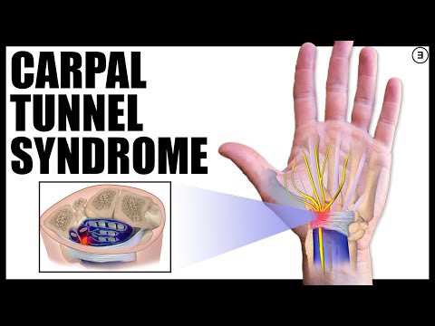 Carpal Tunnel Syndrome (Diagnosis Explained | Science Based)