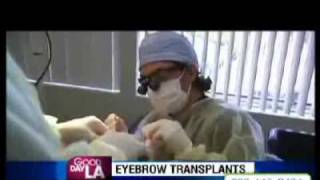 Eyebrow Transplant by Dr. Sean Behnam Eyebrow Transplant by Dr. Sean Behnam