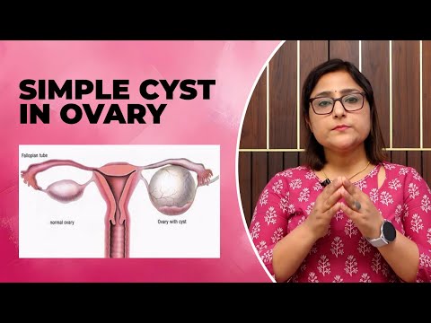 Simple ovarian cyst, cyst in the ovary - what to do