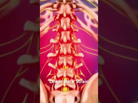 Lower Back Strain