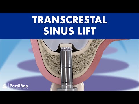 TRANSCRESTAL sinus lift - IMPLANT placement for BONELESS patients ©