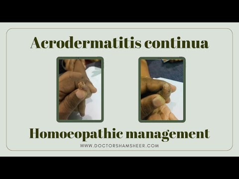 Acrodermatitis and continua -Abel from  thrisure  and took 3 month to cure