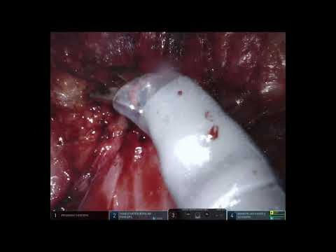 Dissection of Rectovaginal Endometriosis with Linear Stapled Nodulectomy of Multifocal Bowel Disease