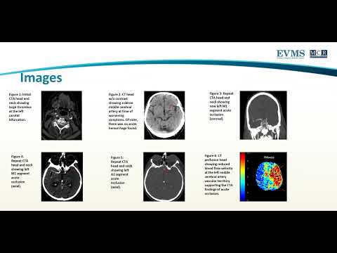 Thumbnail image of video presentation for Imaging Considerations for Acute Stroke with Clinical Case Presentation