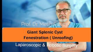 Miniaturka - Giant Splenic Cyst. Fenestration (unroofing). Metin Ertem. MD.FACS.