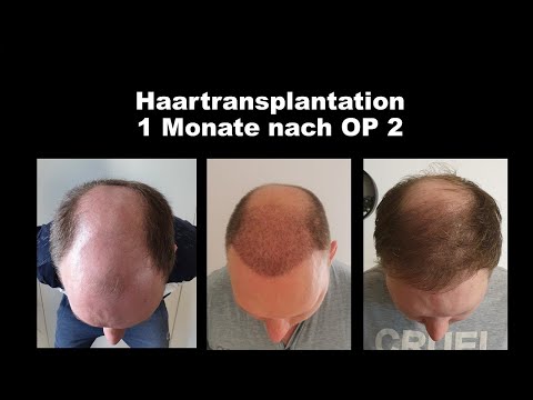Haartransplantation 8.300 Grafts Erfahrungen 2 OP