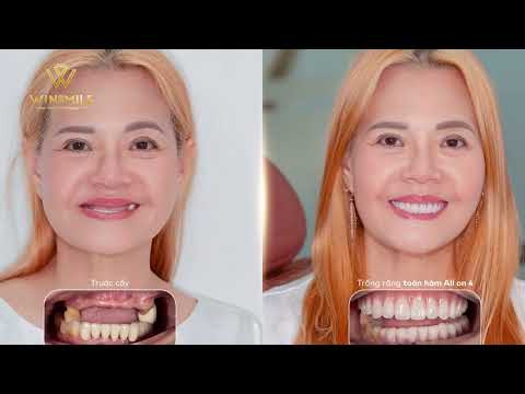 Trồng Implant cải thiện ăn nhai cho hai vợ chồng Việt kiều Thụy Sĩ| Nha khoa Win Smile