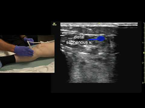 Ultrasound to find the Distal Saphenous Vein